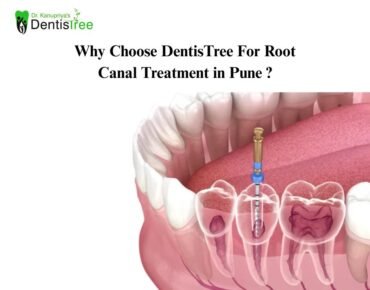 Root Canal Treatment in Undri Pune | Why Choose DentisTree