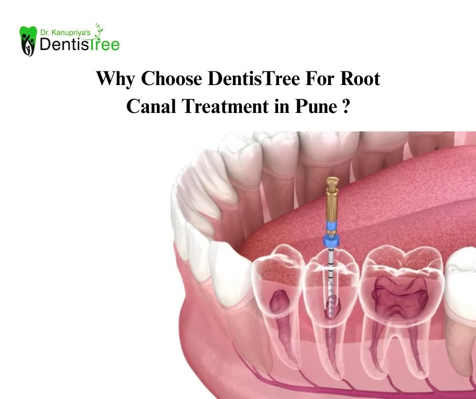 Root Canal Treatment in Undri Pune | Why Choose DentisTree